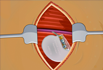 Operate Now Pacemaker Surgery